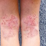 eczema leg