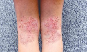 eczema leg
