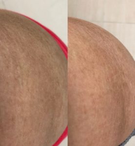 xczema pro_before & after