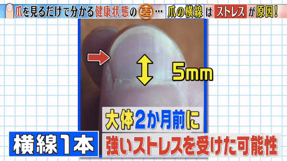教你分辦6個常見指甲健康徵兆-指甲有黑點-癌症-10