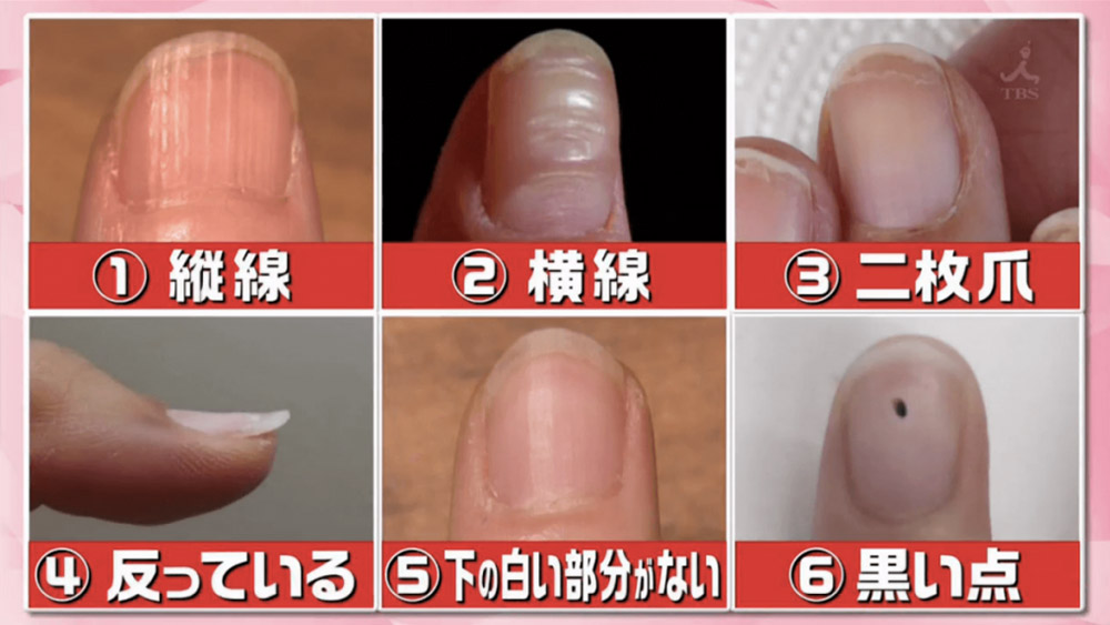 教你分辦6個常見指甲健康徵兆-指甲有黑點-癌症-2