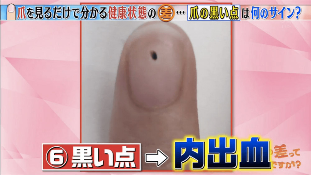 教你分辦6個常見指甲健康徵兆-指甲有黑點-癌症-20