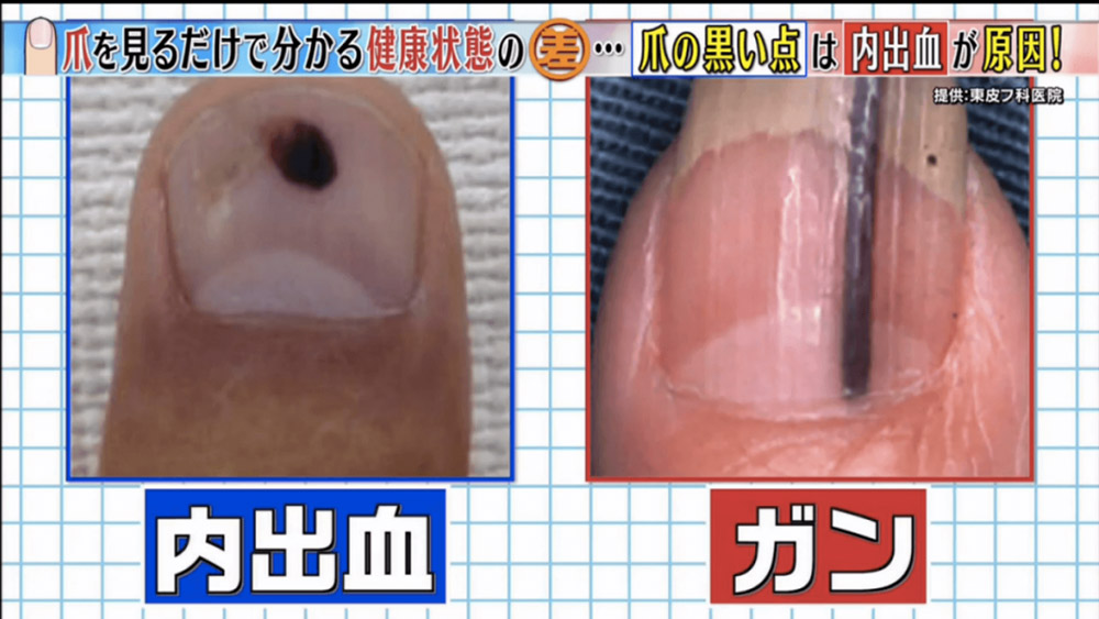 教你分辦6個常見指甲健康徵兆-指甲有黑點-癌症-21