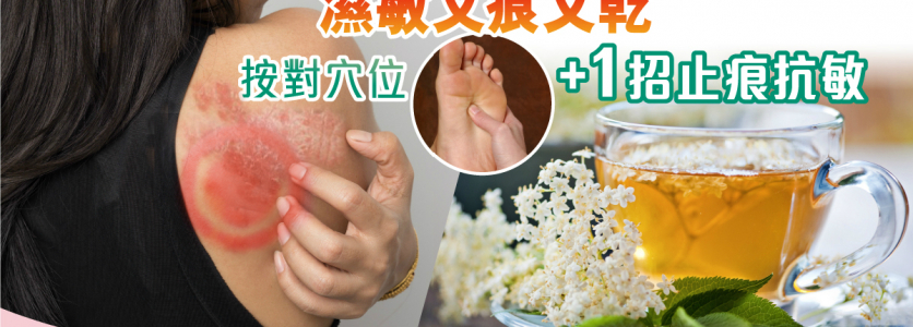 濕敏又痕又乾 按對穴位+1招止痕抗敏