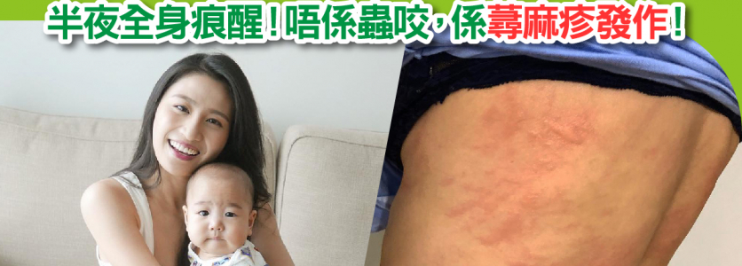 日本醫學博士: 五大族群易中招！半夜全身痕醒！唔係蟲咬，係蕁麻疹發作！